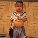 Young boy with pot-belly from the Kmou Tribe, Laos.
